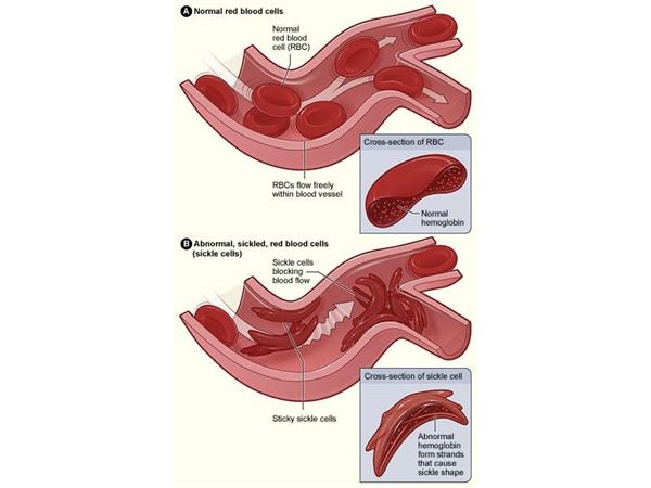 Диагностика серповидноклеточной анемии