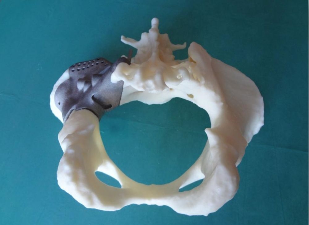 Напечатанные кости. Имплант челюсти 3д принтер. Искусственная кость.