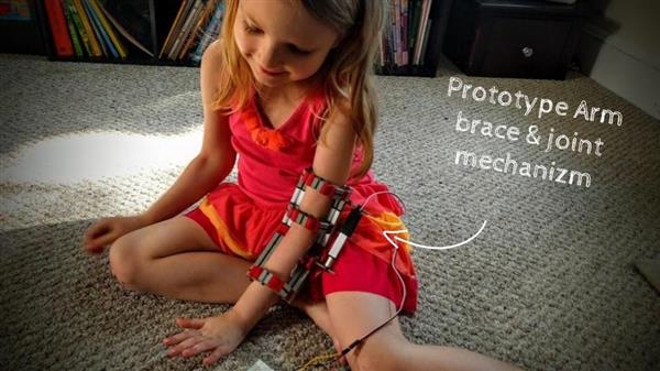 Миоэлектрический протез локтя для 5-летней девочки