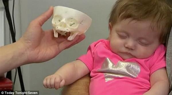 Напечатанная модель черепа спасает австралийского ребенка